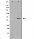 DF6330 at 1/100 staining Human liver cancer tissue by IHC-P. The sample was formaldehyde fixed and a heat mediated antigen retrieval step in citrate buffer was performed. The sample was then blocked and incubated with the antibody for 1.5 hours at 22¡ãC. An HRP conjugated goat anti-rabbit antibody was used as the secondary