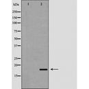 DF6336 at 1/100 staining Human Melanoma tissue by IHC-P. The sample was formaldehyde fixed and a heat mediated antigen retrieval step in citrate buffer was performed. The sample was then blocked and incubated with the antibody for 1.5 hours at 22¡ãC. An HRP conjugated goat anti-rabbit antibody was used as the secondary