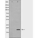 DF6381 at 1/100 staining Human liver cancer tissue by IHC-P. The sample was formaldehyde fixed and a heat mediated antigen retrieval step in citrate buffer was performed. The sample was then blocked and incubated with the antibody for 1.5 hours at 22¡ãC. An HRP conjugated goat anti-rabbit antibody was used as the secondary