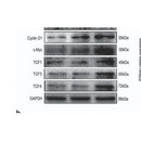 DF6386 at 1/200 staining human Breast cancer tissue sections by IHC-P. The tissue was formaldehyde fixed and a heat mediated antigen retrieval step in citrate buffer was performed. The tissue was then blocked and incubated with the antibody for 1.5 hours at 22¡ãC. An HRP conjugated goat anti-rabbit antibody was used as the secondary