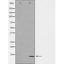 DF6389 at 1/100 staining Human Melanoma tissue by IHC-P. The sample was formaldehyde fixed and a heat mediated antigen retrieval step in citrate buffer was performed. The sample was then blocked and incubated with the antibody for 1.5 hours at 22¡ãC. An HRP conjugated goat anti-rabbit antibody was used as the secondary