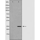 DF6390 at 1/100 staining Human cervical cancer tissue by IHC-P. The sample was formaldehyde fixed and a heat mediated antigen retrieval step in citrate buffer was performed. The sample was then blocked and incubated with the antibody for 1.5 hours at 22¡ãC. An HRP conjugated goat anti-rabbit antibody was used as the secondary