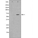 DF6409 at 1/100 staining Human liver cancer tissue by IHC-P. The sample was formaldehyde fixed and a heat mediated antigen retrieval step in citrate buffer was performed. The sample was then blocked and incubated with the antibody for 1.5 hours at 22¡ãC. An HRP conjugated goat anti-rabbit antibody was used as the secondary