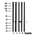 DF6413 at 1/100 staining Human liver cancer tissue by IHC-P. The sample was formaldehyde fixed and a heat mediated antigen retrieval step in citrate buffer was performed. The sample was then blocked and incubated with the antibody for 1.5 hours at 22¡ãC. An HRP conjugated goat anti-rabbit antibody was used as the secondary