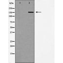 DF6424 at 1/100 staining Human liver cancer tissue by IHC-P. The sample was formaldehyde fixed and a heat mediated antigen retrieval step in citrate buffer was performed. The sample was then blocked and incubated with the antibody for 1.5 hours at 22¡ãC. An HRP conjugated goat anti-rabbit antibody was used as the secondary