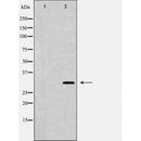 DF6437 at 1/100 staining Human cervical cancer tissue by IHC-P. The sample was formaldehyde fixed and a heat mediated antigen retrieval step in citrate buffer was performed. The sample was then blocked and incubated with the antibody for 1.5 hours at 22¡ãC. An HRP conjugated goat anti-rabbit antibody was used as the secondary