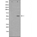 DF6463 at 1/100 staining Human liver cancer tissue by IHC-P. The sample was formaldehyde fixed and a heat mediated antigen retrieval step in citrate buffer was performed. The sample was then blocked and incubated with the antibody for 1.5 hours at 22¡ãC. An HRP conjugated goat anti-rabbit antibody was used as the secondary