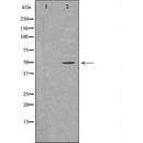 DF6505 at 1/100 staining Human liver cancer tissue by IHC-P. The sample was formaldehyde fixed and a heat mediated antigen retrieval step in citrate buffer was performed. The sample was then blocked and incubated with the antibody for 1.5 hours at 22¡ãC. An HRP conjugated goat anti-rabbit antibody was used as the secondary