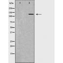 DF6525 at 1/100 staining Human liver cancer tissue by IHC-P. The sample was formaldehyde fixed and a heat mediated antigen retrieval step in citrate buffer was performed. The sample was then blocked and incubated with the antibody for 1.5 hours at 22¡ãC. An HRP conjugated goat anti-rabbit antibody was used as the secondary