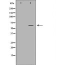 DF6549 at 1/100 staining Human urothelial cancer tissue by IHC-P. The sample was formaldehyde fixed and a heat mediated antigen retrieval step in citrate buffer was performed. The sample was then blocked and incubated with the antibody for 1.5 hours at 22¡ãC. An HRP conjugated goat anti-rabbit antibody was used as the secondary
