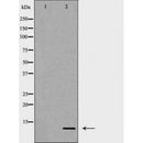 DF6581 at 1/100 staining Human Melanoma tissue by IHC-P. The sample was formaldehyde fixed and a heat mediated antigen retrieval step in citrate buffer was performed. The sample was then blocked and incubated with the antibody for 1.5 hours at 22¡ãC. An HRP conjugated goat anti-rabbit antibody was used as the secondary