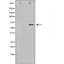 DF6589 at 1/100 staining Human liver cancer tissue by IHC-P. The sample was formaldehyde fixed and a heat mediated antigen retrieval step in citrate buffer was performed. The sample was then blocked and incubated with the antibody for 1.5 hours at 22¡ãC. An HRP conjugated goat anti-rabbit antibody was used as the secondary