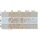 DF6594 at 1/100 staining Human liver cancer tissue by IHC-P. The sample was formaldehyde fixed and a heat mediated antigen retrieval step in citrate buffer was performed. The sample was then blocked and incubated with the antibody for 1.5 hours at 22¡ãC. An HRP conjugated goat anti-rabbit antibody was used as the secondary