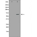 DF6643 at 1/100 staining Human brain cancer tissue by IHC-P. The sample was formaldehyde fixed and a heat mediated antigen retrieval step in citrate buffer was performed. The sample was then blocked and incubated with the antibody for 1.5 hours at 22¡ãC. An HRP conjugated goat anti-rabbit antibody was used as the secondary