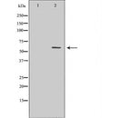 DF6671 at 1/100 staining Human liver cancer tissue by IHC-P. The sample was formaldehyde fixed and a heat mediated antigen retrieval step in citrate buffer was performed. The sample was then blocked and incubated with the antibody for 1.5 hours at 22¡ãC. An HRP conjugated goat anti-rabbit antibody was used as the secondary