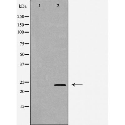 DF6672 at 1/100 staining Human Melanoma tissue by IHC-P. The sample was formaldehyde fixed and a heat mediated antigen retrieval step in citrate buffer was performed. The sample was then blocked and incubated with the antibody for 1.5 hours at 22¡ãC. An HRP conjugated goat anti-rabbit antibody was used as the secondary