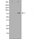 DF6673 at 1/100 staining Human liver cancer tissue by IHC-P. The sample was formaldehyde fixed and a heat mediated antigen retrieval step in citrate buffer was performed. The sample was then blocked and incubated with the antibody for 1.5 hours at 22¡ãC. An HRP conjugated goat anti-rabbit antibody was used as the secondary