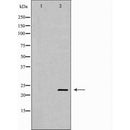 DF6689 at 1/100 staining Human Melanoma tissue by IHC-P. The sample was formaldehyde fixed and a heat mediated antigen retrieval step in citrate buffer was performed. The sample was then blocked and incubated with the antibody for 1.5 hours at 22¡ãC. An HRP conjugated goat anti-rabbit antibody was used as the secondary