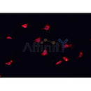 DF6699 at 1/100 staining Human urothelial cancer tissue by IHC-P. The sample was formaldehyde fixed and a heat mediated antigen retrieval step in citrate buffer was performed. The sample was then blocked and incubated with the antibody for 1.5 hours at 22¡ãC. An HRP conjugated goat anti-rabbit antibody was used as the secondary
