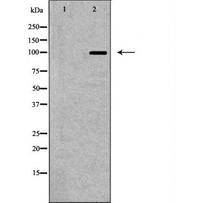 DF6706 at 1/100 staining Human liver cancer tissue by IHC-P. The sample was formaldehyde fixed and a heat mediated antigen retrieval step in citrate buffer was performed. The sample was then blocked and incubated with the antibody for 1.5 hours at 22¡ãC. An HRP conjugated goat anti-rabbit antibody was used as the secondary