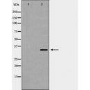DF6767 at 1/100 staining Human liver cancer tissue by IHC-P. The sample was formaldehyde fixed and a heat mediated antigen retrieval step in citrate buffer was performed. The sample was then blocked and incubated with the antibody for 1.5 hours at 22¡ãC. An HRP conjugated goat anti-rabbit antibody was used as the secondary