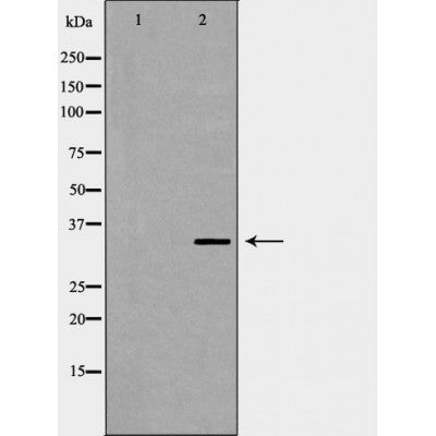 DF6767 at 1/100 staining Human liver cancer tissue by IHC-P. The sample was formaldehyde fixed and a heat mediated antigen retrieval step in citrate buffer was performed. The sample was then blocked and incubated with the antibody for 1.5 hours at 22¡ãC. An HRP conjugated goat anti-rabbit antibody was used as the secondary