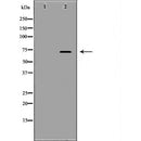 DF6776 at 1/100 staining Human urothelial cancer tissue by IHC-P. The sample was formaldehyde fixed and a heat mediated antigen retrieval step in citrate buffer was performed. The sample was then blocked and incubated with the antibody for 1.5 hours at 22¡ãC. An HRP conjugated goat anti-rabbit antibody was used as the secondary
