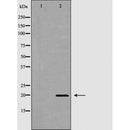 DF6777 at 1/100 staining Human Head and neck cancer tissue by IHC-P. The sample was formaldehyde fixed and a heat mediated antigen retrieval step in citrate buffer was performed. The sample was then blocked and incubated with the antibody for 1.5 hours at 22¡ãC. An HRP conjugated goat anti-rabbit antibody was used as the secondary