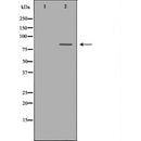 DF6787 at 1/100 staining Human breast cancer tissue by IHC-P. The sample was formaldehyde fixed and a heat mediated antigen retrieval step in citrate buffer was performed. The sample was then blocked and incubated with the antibody for 1.5 hours at 22¡ãC. An HRP conjugated goat anti-rabbit antibody was used as the secondary
