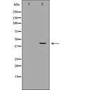 DF6789 at 1/100 staining Human liver cancer tissue by IHC-P. The sample was formaldehyde fixed and a heat mediated antigen retrieval step in citrate buffer was performed. The sample was then blocked and incubated with the antibody for 1.5 hours at 22¡ãC. An HRP conjugated goat anti-rabbit antibody was used as the secondary