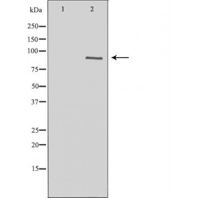 DF6823 at 1/100 staining Human brain cancer tissue by IHC-P. The sample was formaldehyde fixed and a heat mediated antigen retrieval step in citrate buffer was performed. The sample was then blocked and incubated with the antibody for 1.5 hours at 22¡ãC. An HRP conjugated goat anti-rabbit antibody was used as the secondary