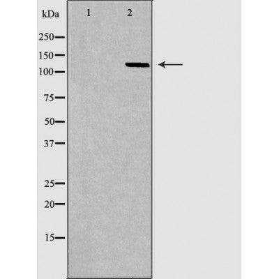DF6827 at 1/100 staining Human liver cancer tissue by IHC-P. The sample was formaldehyde fixed and a heat mediated antigen retrieval step in citrate buffer was performed. The sample was then blocked and incubated with the antibody for 1.5 hours at 22¡ãC. An HRP conjugated goat anti-rabbit antibody was used as the secondary