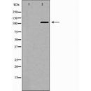 DF6838 at 1/100 staining Human breast cancer tissue by IHC-P. The sample was formaldehyde fixed and a heat mediated antigen retrieval step in citrate buffer was performed. The sample was then blocked and incubated with the antibody for 1.5 hours at 22¡ãC. An HRP conjugated goat anti-rabbit antibody was used as the secondary