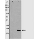 DF6849 at 1/100 staining Human liver cancer tissue by IHC-P. The sample was formaldehyde fixed and a heat mediated antigen retrieval step in citrate buffer was performed. The sample was then blocked and incubated with the antibody for 1.5 hours at 22¡ãC. An HRP conjugated goat anti-rabbit antibody was used as the secondary