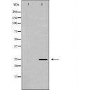 DF6854 at 1/100 staining Human brain cancer tissue by IHC-P. The sample was formaldehyde fixed and a heat mediated antigen retrieval step in citrate buffer was performed. The sample was then blocked and incubated with the antibody for 1.5 hours at 22¡ãC. An HRP conjugated goat anti-rabbit antibody was used as the secondary