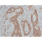 AF0131 at 1/50 staining human colon cancer tissue sections by IHC-P. The tissue was formaldehyde fixed and a heat mediated antigen retrieval step in citrate buffer was performed. The tissue was then blocked and incubated with the antibody for 1.5 hours at 22¡ãC. An HRP conjugated goat anti-rabbit antibody was used as the secondary