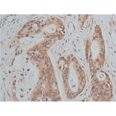 AF0131 at 1/50 staining human colon cancer tissue sections by IHC-P. The tissue was formaldehyde fixed and a heat mediated antigen retrieval step in citrate buffer was performed. The tissue was then blocked and incubated with the antibody for 1.5 hours at 22¡ãC. An HRP conjugated goat anti-rabbit antibody was used as the secondary