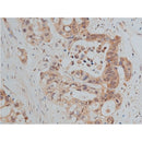 AF0131 at 1/50 staining human colon cancer tissue sections by IHC-P. The tissue was formaldehyde fixed and a heat mediated antigen retrieval step in citrate buffer was performed. The tissue was then blocked and incubated with the antibody for 1.5 hours at 22¡ãC. An HRP conjugated goat anti-rabbit antibody was used as the secondary