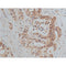 AF0131 at 1/50 staining human colon cancer tissue sections by IHC-P. The tissue was formaldehyde fixed and a heat mediated antigen retrieval step in citrate buffer was performed. The tissue was then blocked and incubated with the antibody for 1.5 hours at 22¡ãC. An HRP conjugated goat anti-rabbit antibody was used as the secondary