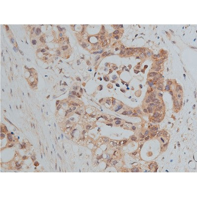 AF0131 at 1/50 staining human colon cancer tissue sections by IHC-P. The tissue was formaldehyde fixed and a heat mediated antigen retrieval step in citrate buffer was performed. The tissue was then blocked and incubated with the antibody for 1.5 hours at 22¡ãC. An HRP conjugated goat anti-rabbit antibody was used as the secondary