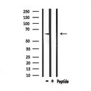 DF6914 at 1/100 staining Human liver cancer tissue by IHC-P. The sample was formaldehyde fixed and a heat mediated antigen retrieval step in citrate buffer was performed. The sample was then blocked and incubated with the antibody for 1.5 hours at 22¡ãC. An HRP conjugated goat anti-rabbit antibody was used as the secondary