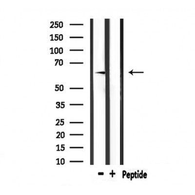DF6914 at 1/100 staining Human liver cancer tissue by IHC-P. The sample was formaldehyde fixed and a heat mediated antigen retrieval step in citrate buffer was performed. The sample was then blocked and incubated with the antibody for 1.5 hours at 22¡ãC. An HRP conjugated goat anti-rabbit antibody was used as the secondary