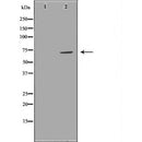 DF6918 at 1/100 staining Human liver cancer tissue by IHC-P. The sample was formaldehyde fixed and a heat mediated antigen retrieval step in citrate buffer was performed. The sample was then blocked and incubated with the antibody for 1.5 hours at 22¡ãC. An HRP conjugated goat anti-rabbit antibody was used as the secondary