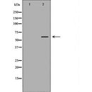 DF6967 at 1/100 staining Human brain cancer tissue by IHC-P. The sample was formaldehyde fixed and a heat mediated antigen retrieval step in citrate buffer was performed. The sample was then blocked and incubated with the antibody for 1.5 hours at 22¡ãC. An HRP conjugated goat anti-rabbit antibody was used as the secondary