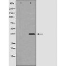 DF6990 at 1/100 staining Human liver cancer tissue by IHC-P. The sample was formaldehyde fixed and a heat mediated antigen retrieval step in citrate buffer was performed. The sample was then blocked and incubated with the antibody for 1.5 hours at 22¡ãC. An HRP conjugated goat anti-rabbit antibody was used as the secondary