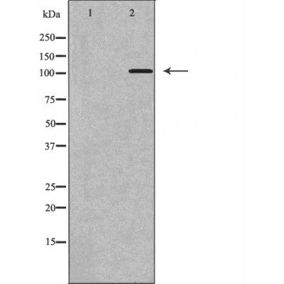 DF6996 at 1/100 staining Human cervical cancer tissue by IHC-P. The sample was formaldehyde fixed and a heat mediated antigen retrieval step in citrate buffer was performed. The sample was then blocked and incubated with the antibody for 1.5 hours at 22¡ãC. An HRP conjugated goat anti-rabbit antibody was used as the secondary