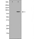 DF6997 at 1/100 staining Human breast cancer tissue by IHC-P. The sample was formaldehyde fixed and a heat mediated antigen retrieval step in citrate buffer was performed. The sample was then blocked and incubated with the antibody for 1.5 hours at 22¡ãC. An HRP conjugated goat anti-rabbit antibody was used as the secondary