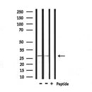 DF7007 at 1/100 staining Human urothelial cancer tissue by IHC-P. The sample was formaldehyde fixed and a heat mediated antigen retrieval step in citrate buffer was performed. The sample was then blocked and incubated with the antibody for 1.5 hours at 22¡ãC. An HRP conjugated goat anti-rabbit antibody was used as the secondary