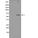 DF7009 at 1/100 staining Human liver cancer tissue by IHC-P. The sample was formaldehyde fixed and a heat mediated antigen retrieval step in citrate buffer was performed. The sample was then blocked and incubated with the antibody for 1.5 hours at 22¡ãC. An HRP conjugated goat anti-rabbit antibody was used as the secondary