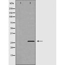 DF7039 at 1/100 staining Human brain cancer tissue by IHC-P. The sample was formaldehyde fixed and a heat mediated antigen retrieval step in citrate buffer was performed. The sample was then blocked and incubated with the antibody for 1.5 hours at 22¡ãC. An HRP conjugated goat anti-rabbit antibody was used as the secondary